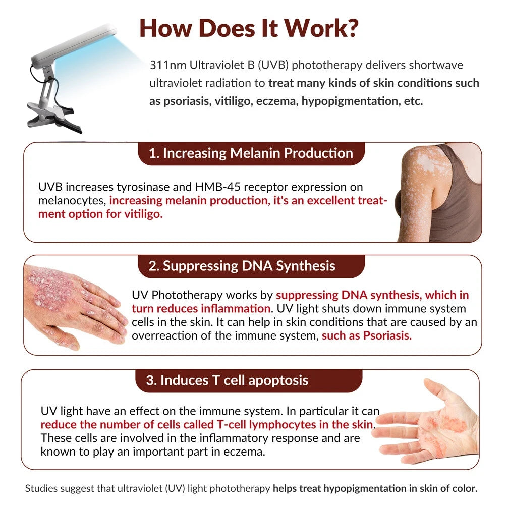 Treatment of vitiligo psoriasis with 311 NM narrow-band ultraviolet light by UVB phototherapy instrument