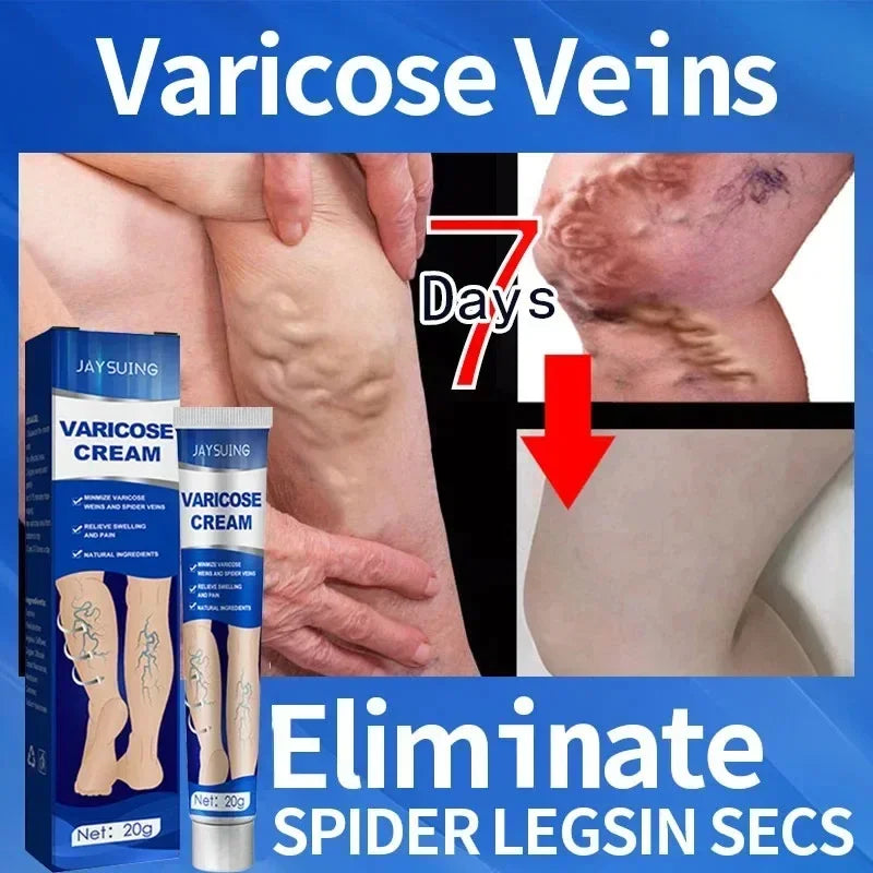 Ointment for Varicose Veins Eliminate .