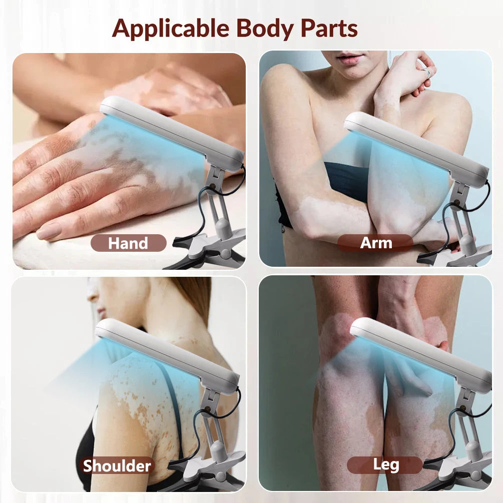 Treatment of vitiligo psoriasis with 311 NM narrow-band ultraviolet light by UVB phototherapy instrument