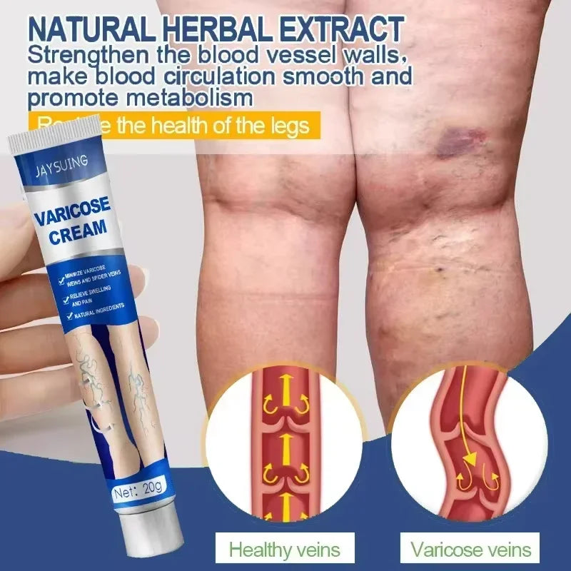 Ointment for Varicose Veins Eliminate .