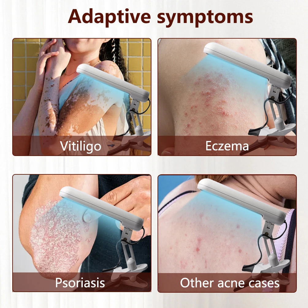Treatment of vitiligo psoriasis with 311 NM narrow-band ultraviolet light by UVB phototherapy instrument
