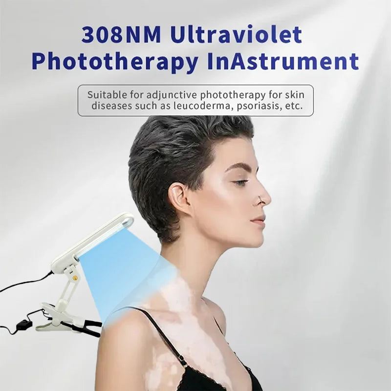 Treatment of vitiligo psoriasis with 311 NM narrow-band ultraviolet light by UVB phototherapy instrument