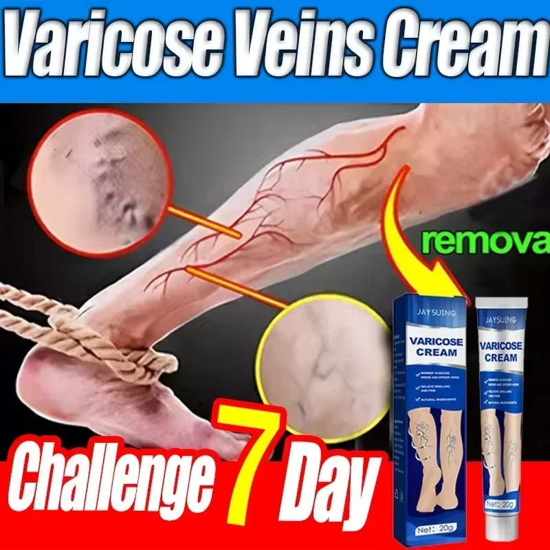 Ointment for Varicose Veins Eliminate .