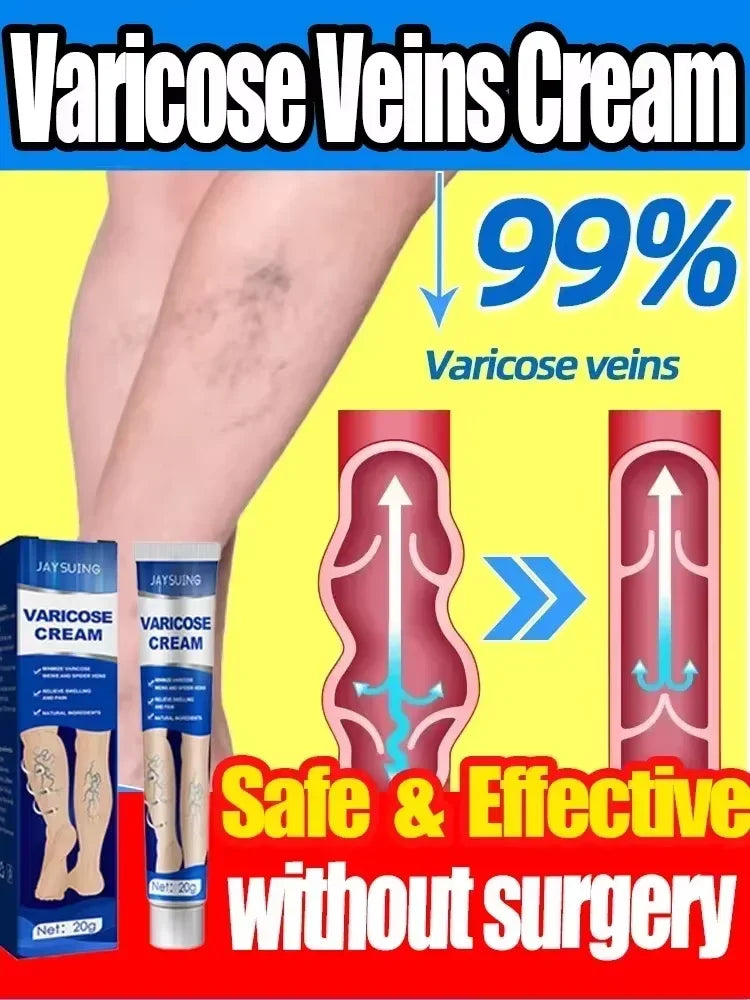 Ointment for Varicose Veins Eliminate .