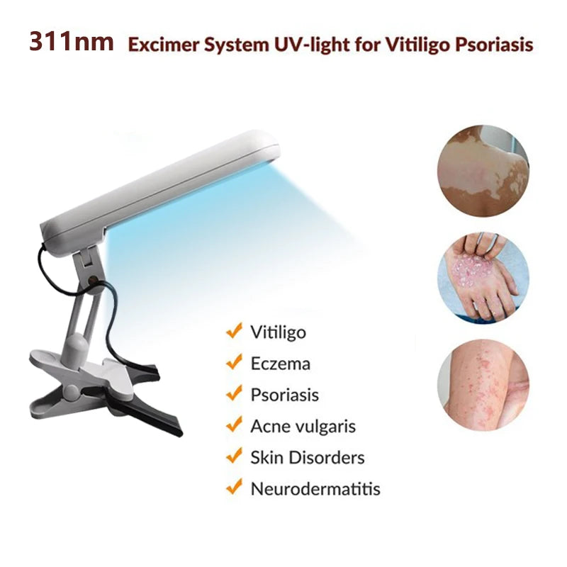 Treatment of vitiligo psoriasis with 311 NM narrow-band ultraviolet light by UVB phototherapy instrument