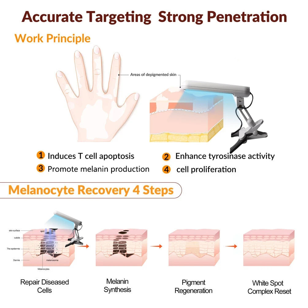 Treatment of vitiligo psoriasis with 311 NM narrow-band ultraviolet light by UVB phototherapy instrument