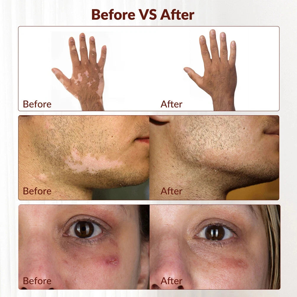 Treatment of vitiligo psoriasis with 311 NM narrow-band ultraviolet light by UVB phototherapy instrument