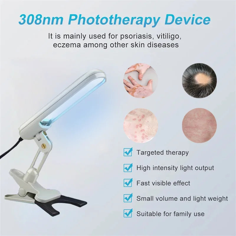 Treatment of vitiligo psoriasis with 311 NM narrow-band ultraviolet light by UVB phototherapy instrument